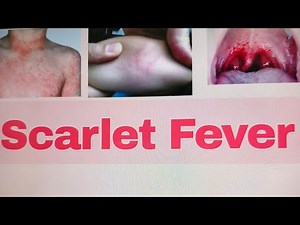 Scarlet fever ,Scarlet Fever etiology, clinical features, complications, investigations ,treatment