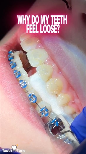 BRACES FAQs ‼️🦷🪥 Tooth Time Family Dentistry