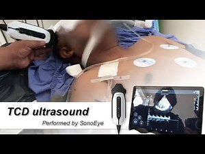 Transcranial Doppler Ultrasound using SonoEye