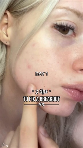 how i fixed a massive breakout in 3 days! 💌 (and also prevent dark spots😭) #acne #azelaicacid #skin1004 #koreanskincare #centella @SKIN1004 US