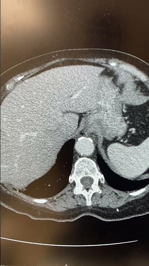 Video A: Top 5 Symptoms of Adrenal Pheochromocytoma