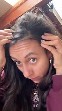 How I CURED my seborrheic dermatitis and dandruff in 1 week!!