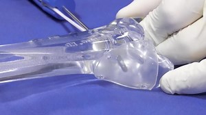 Video: How Syndesmosis TightRope implant works to help athletes