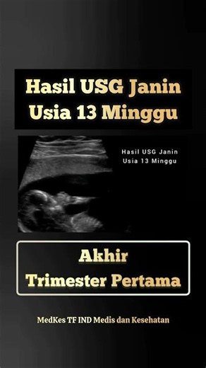 Hasil USG Janin Usia 13 Minggu | Akhir Trimester Pertama