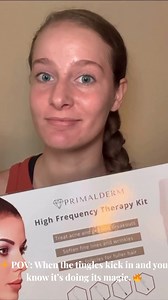 See how Primalderm High-Frequency Therapy is helping people achieve clearer, healthier skin. From fighting stubborn breakouts to fading acne scars and reducing redness, our customers are loving their results! ⚡ ✔️ Eliminates acne-causing bacteria ✔️ Reduces inflammation & breakouts ✔️ Speeds up skin healing for a smoother glow Ready to start your acne-free journey? Watch their transformations & Click the link: https://www.primalderm.co/collections/shop/products/primalderm-high-frequency-therapy?