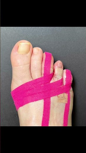 BRACHYMETATARSIA SURGERY (Before & After) ♥️#shorts #brachymetatarsia #toelengthening