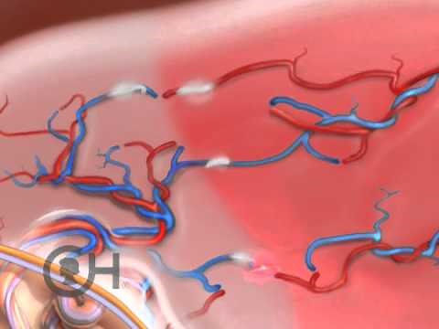 Treatment Options: Twin-Twin Transfusion Syndrome (TTTS) (5 of 9)