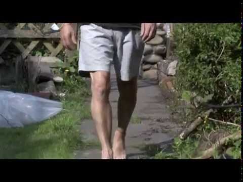 High Tibial Osteotomy Diary of a procedure