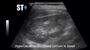 Medullary Nephrocalcinosis in a patient with hypercalcemia | John Z Wetmore