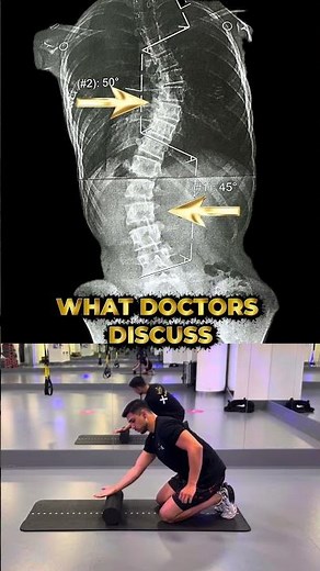 Comment "SCOLIOSIS" and I'll show you the first assessment step.