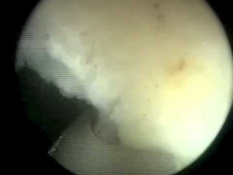 Morcellation of Prostate Tissue (HoLEP) using Wolf Piranha Morcellator