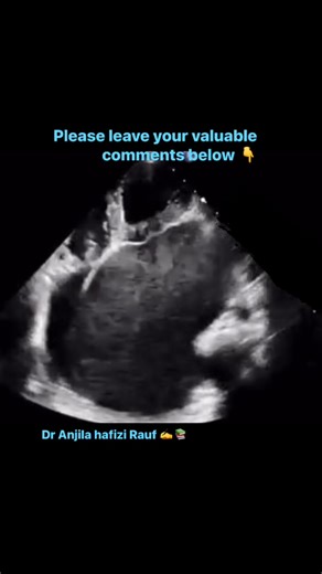 1.7K views · 18 reactions | Mitral Stenosis means the mitral valve...