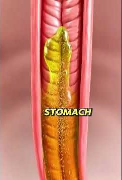 Types of Ulcers Explained (Causes & Prevention) | Part 1