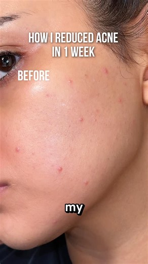 Samara Alam | Do you have acne? 🥺 Try @ao2_Clear ad 👉 Comment “CLEAR” to get the LlNK and code for 20% off the 30 or 60 day supply! 💕 Use code... | Instagram