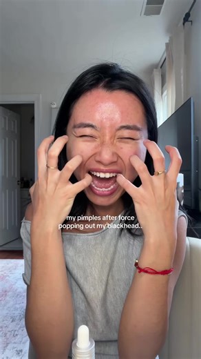 Dangers of Forcing Pimples: What to Expect After