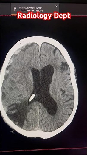 CT Scan Showing VP Shunt ‪@Radiologydept‬ #ctscan #anatomy