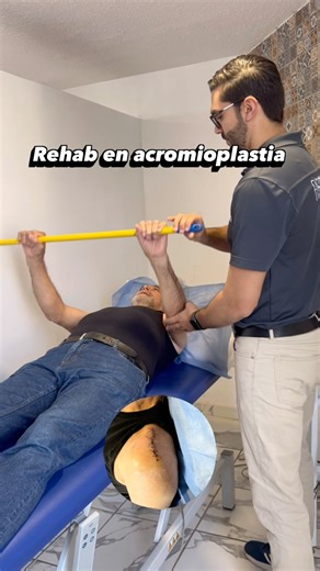 La acromioplastia abierta es un procedimiento quirúrgico que remodela el acromion mediante una incisión más grande para aliviar el dolor causado por el pinzamiento del hombro. A diferencia de la cirugía artroscópica, que usa pequeñas incisiones, la cirugía abierta permite al cirujano una visión más detallada del área, lo que puede ser necesario para reparaciones más complejas. En este caso, la rehabilitación va dirigida al rápido aumento del rango de movimiento del hombro y la fuerza muscular pa
