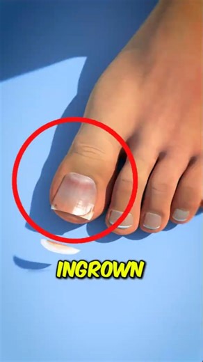 Stop Cutting Your Toenails Like This 😳 It Could Cause Serious Pain!