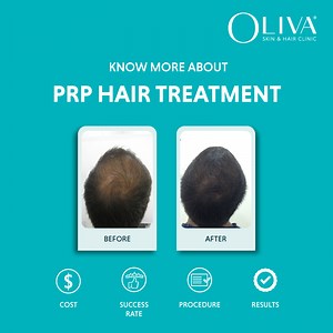 PRP Hair Treatment In India: Cost Starts At INR 5,500, Side Effects & Procedure