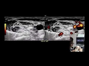 MSK US Guided Hydrodissection of Interscalene Brachial Plexus with 5% Dextrose without Lidocaine