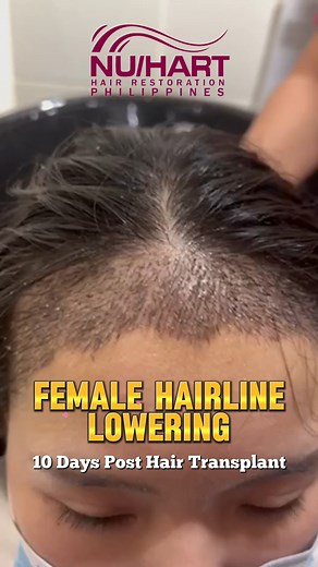 18 reactions | Female Hairline Lowering after 10 days post hair...