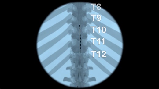 Procedure Training - SCS Perm Animation (2018-03-13) - Trim