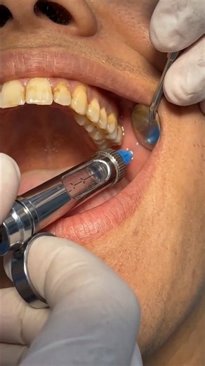 💉🦷dental deep cleaning #Anesthesia #ToothExtraction