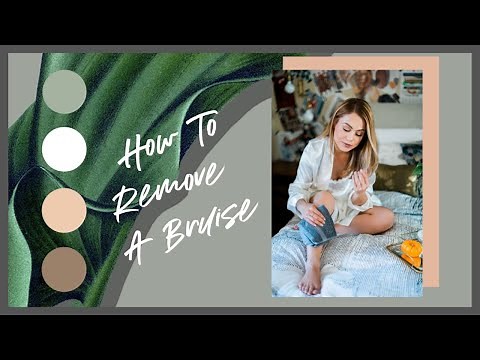 Home Remedies I Removing Bruises Fast