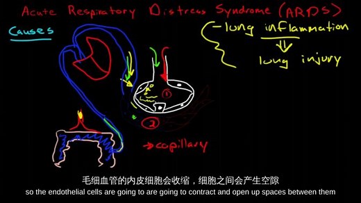 什么是 ARDS 急性呼吸窘迫综合征