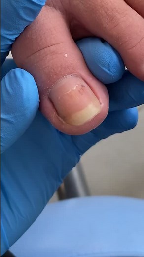 Effective Treatment for Ingrown Toenails at Home