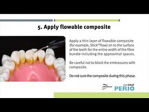 everStick® Perio