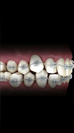Ever wonder how braces actually move teeth?