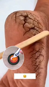 Get rid of cracked heels | Fix cracked heels at home . . . #heels #heel #crackedheels #ridofcrackedheels #repaircrackedheels #feetcare #trendingreels #trending #viral #virals #fypシ゚ #explore #explorepage | YourBeauty Tv
