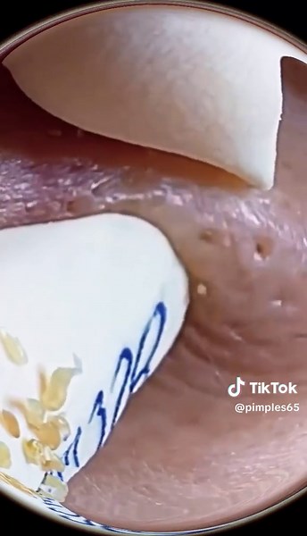 #acnetreatment #pimplepoping #cyst #drpimple #drsandralee #acne #acnetreatments