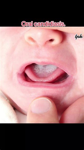 Oral candidiasis, or oral thrush, is a common fungal infection of the mouth caused by an overgrowth of the yeast Candida albicans, appearing as white, cottage cheese-like patches on the tongue, inner cheeks, or roof of the mouth, often with redness or soreness, and usually occurs in babies, the elderly, or those with weakened immune systems or taking certain medications like antibiotics or inhaled steroids, and is treated with antifungal medications.