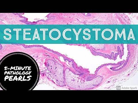 Steatocystoma: 5-Minute Pathology Pearls