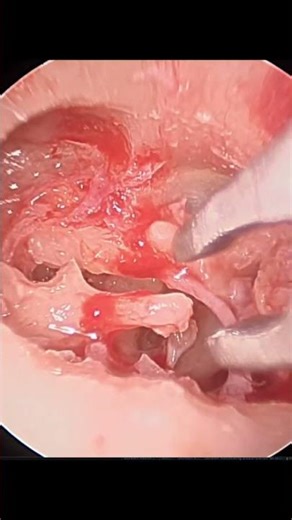 What is an OCR ... An ossicular reconstruction or Ear Bone Rebuilding