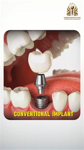 Aik Dant Missing? Poori Smile Khatre Mein | Dental Implant Solution