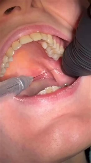 " A Smile Is The Universal Welcome " on Instagram: "Inferior Alveolar Nerve Block 👉𝔽𝕆𝕃𝕃𝕆𝕎 𝔽𝕆ℝ 𝕄𝕆ℝ𝔼 👈 ❤️#Like 📍#Comment 📎#Share 🔄Remix _____________________________________________ dentistry dentstudent odontologia doctor medstudent medicine anatomy surgeon teeth odonto oralhealth health healthylifestyle university students studies fyp foryou viral instagram reels post smile smilempire passion life _____________________________________________"