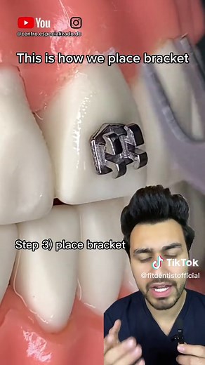 Braces Bracket Placement: Step-by-Step Explanation