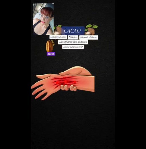 ¿Qué beneficios tiene el cacao para la salud? El cacao es rico en micronutrientes como polifenoles y potentes flavonoides antioxidantes, que ayudan a reducir la inflamación, bajar la presión arterial y mejorar el colesterol y el azúcar en sangre. | Griselda Martinez Gonzalez