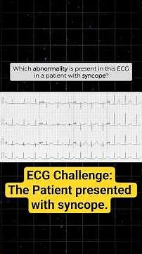 [OSCE: ECG interpretation] Patient with syncope. Which abnormality is present in this ECG?