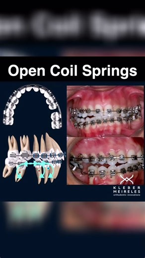 Orthodontic Treatment and Open Springs: Challenges and Side Effects
