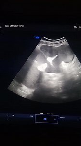 Gross pyonephrosis is secondary to obstructing calculus at uretero pelvic junction. | إستشاري امراض الباطنة والكبد د محمد الجمال