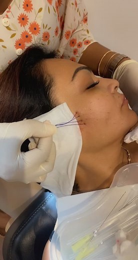 Face Thread Lifting for Saggy Cheeks - Cheek Lift by Dr. Cherry Price