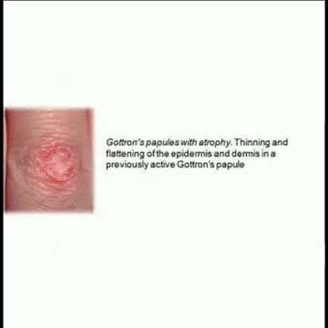 DERMATOMYOSITIS Sign ( Gottron' papule , Shawl sign , Heliottope rash )