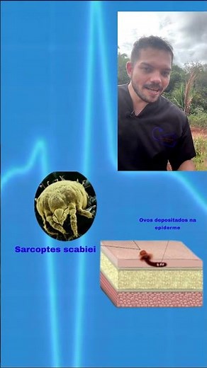 SANASAR - BENZYL BENZOATE - MEDICINE FOR SCABIES AND LICE - HOW TO USE, SIDE EFFECTS