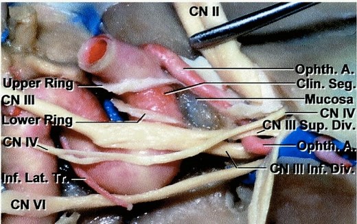 Medial Sphenoid Wing Meningioma | Cohen Collection | Volumes | The Neurosurgical Atlas