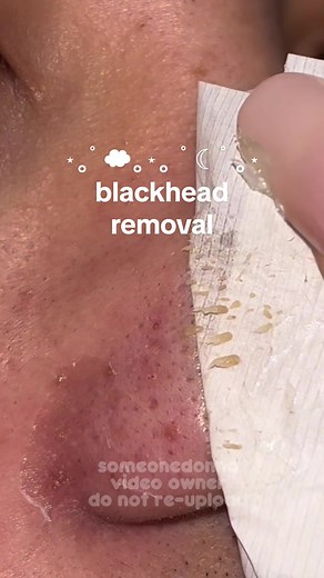 Pagtanggal ng Blackheads: RTopR Mango Remover Review