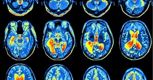 Gadolinium MRI Dye: A Nano Heavy Metal That Insults Your Body